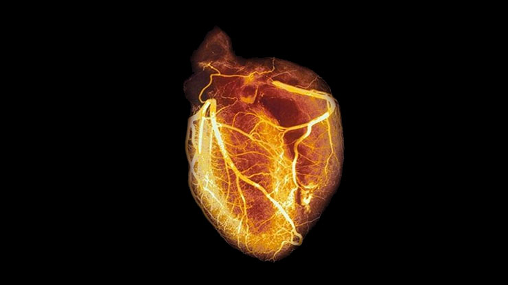 arteriogram